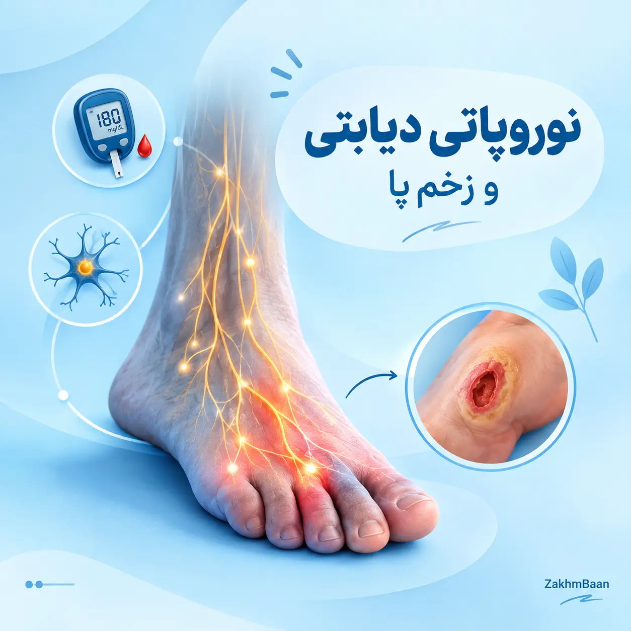 نوروپاتی دیابتی و زخم پا