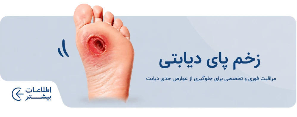 زخم پای دیابتی