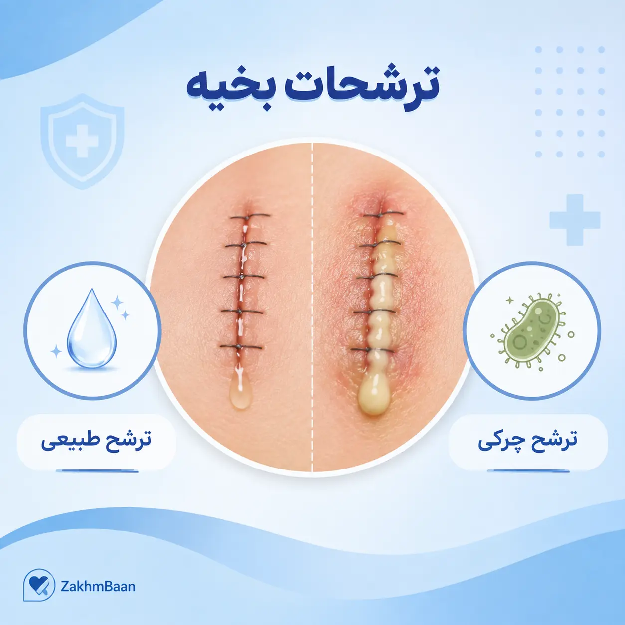 تفاوت بین ترشحات طبیعی (سروما) و ترشحات چرکی (عفونت) از محل بخیه