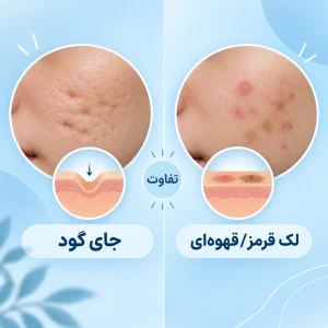 تفاوت جای جوش فرورفته با لک جوش