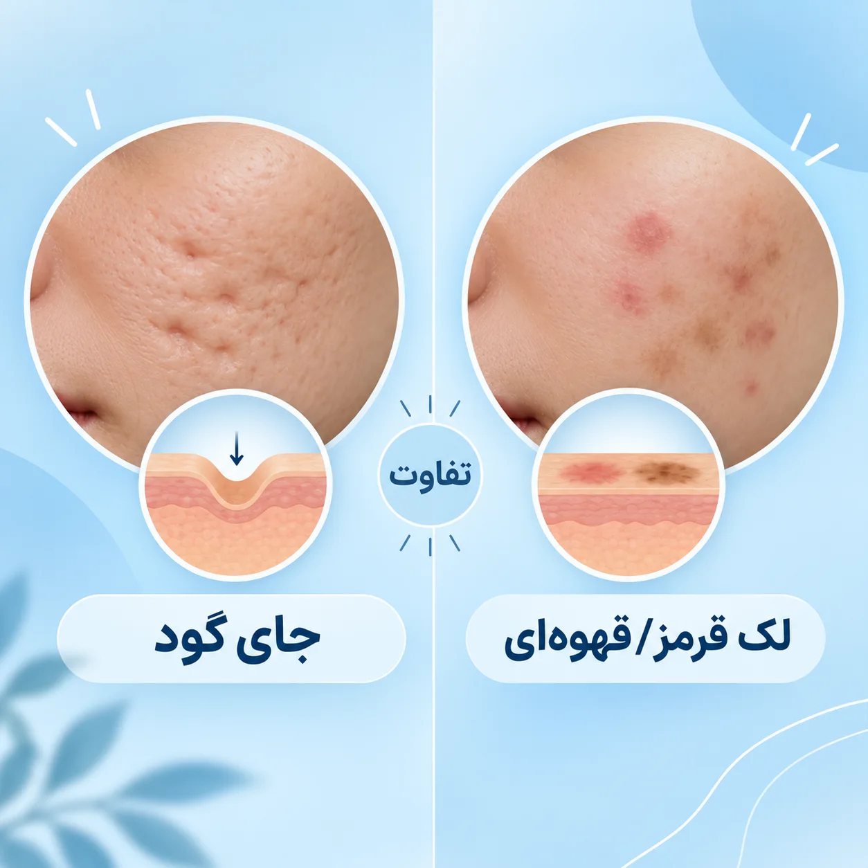 تفاوت جای جوش فرورفته با لک جوش